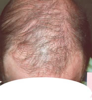 alopecia before