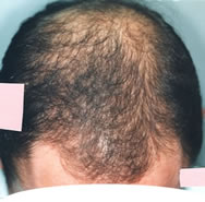 alopecia after