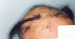 alopecia before